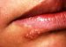herpes-labialis-groznica-na-usnama
